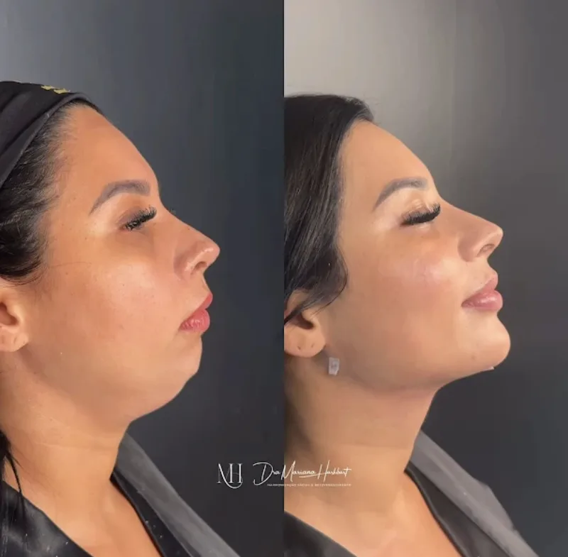 Antes e depois — Contorno Facial