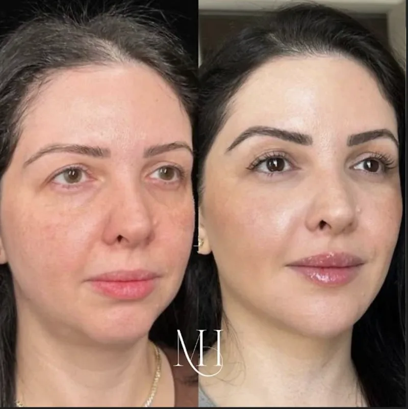 Antes e depois — Harmonização Facial Full Face