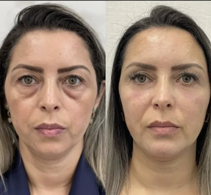 Antes e depois — Line Skin