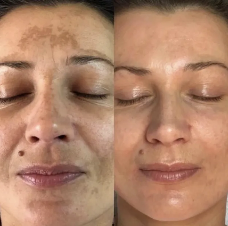 Antes e depois — Protocolo para Melasma
