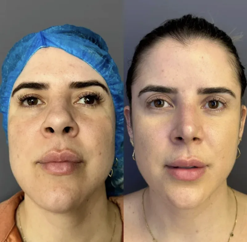 Antes e depois — Rinomodelação Estruturada