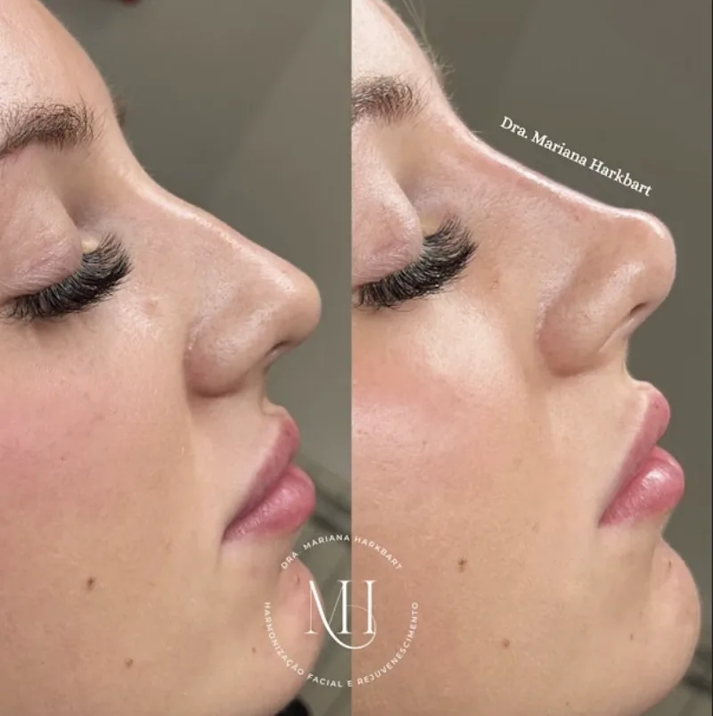 Antes e depois — Rinomodelação