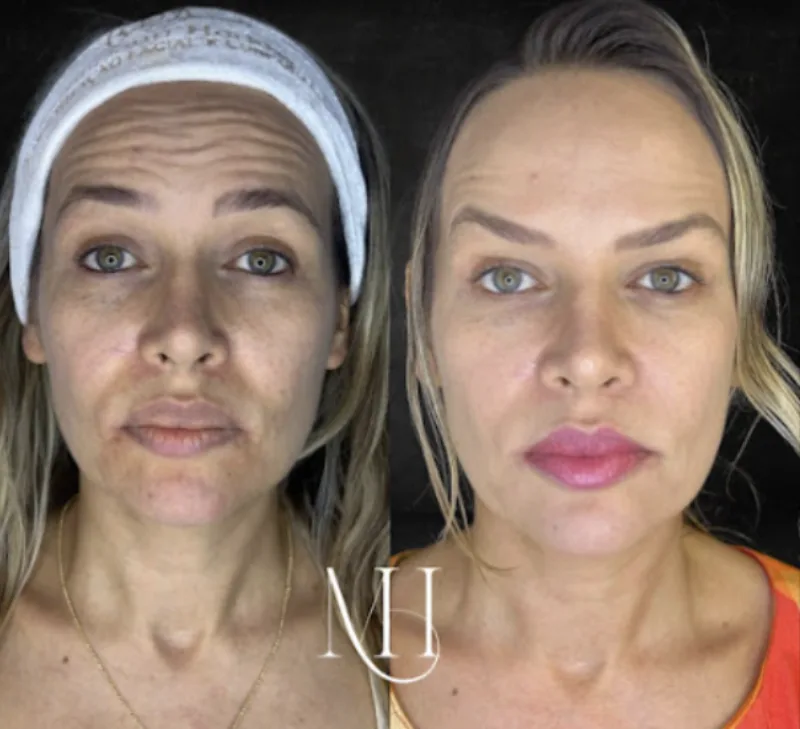 Antes e depois — Toxina Botulínica